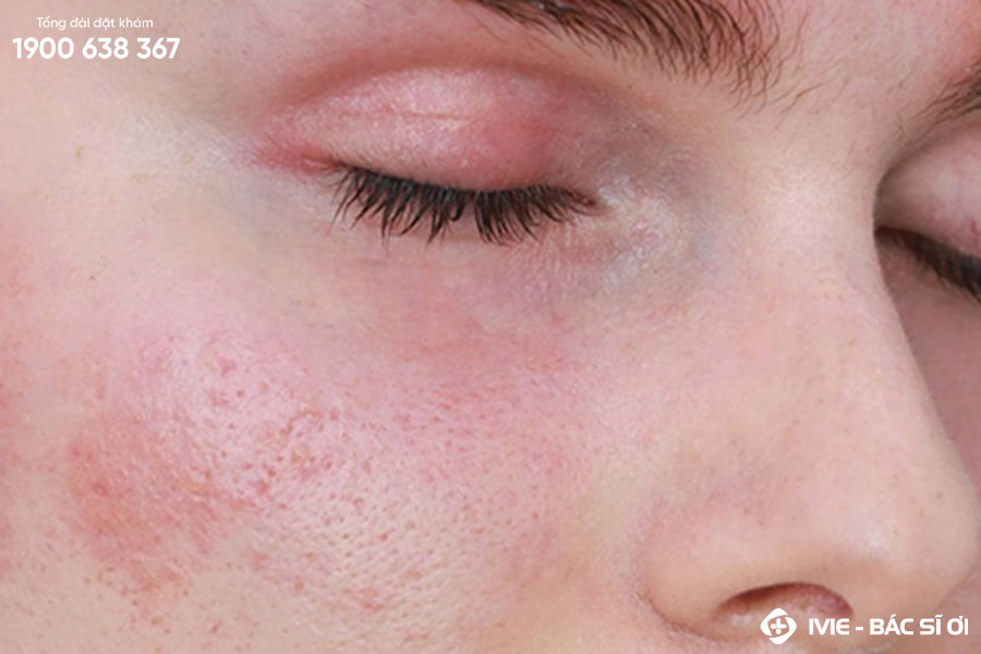 Da bị kích ứng là gì? Nguyên nhân và cách khắc phục helloo88
