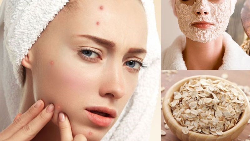 11 cách làm mặt nạ trị mụn helloo88 giúp giảm mụn, trắng da, mờ thâm