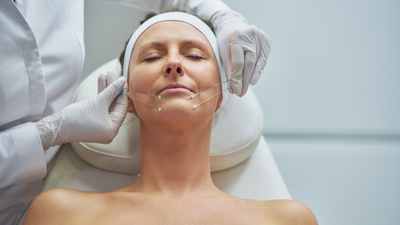 Căng chỉ collagen giá 33hello88 là hợp lý?