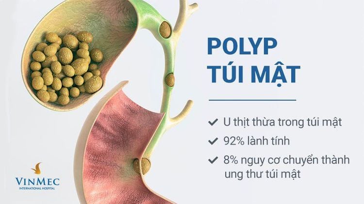 Đa polyp túi mật có hello88.comm không?