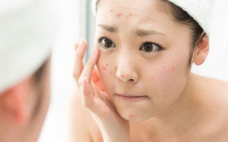 Dấu hiệu bị dị ứng ở mặt