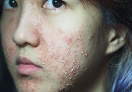 Tại sao da mặt bị ngứa thường xuyên?