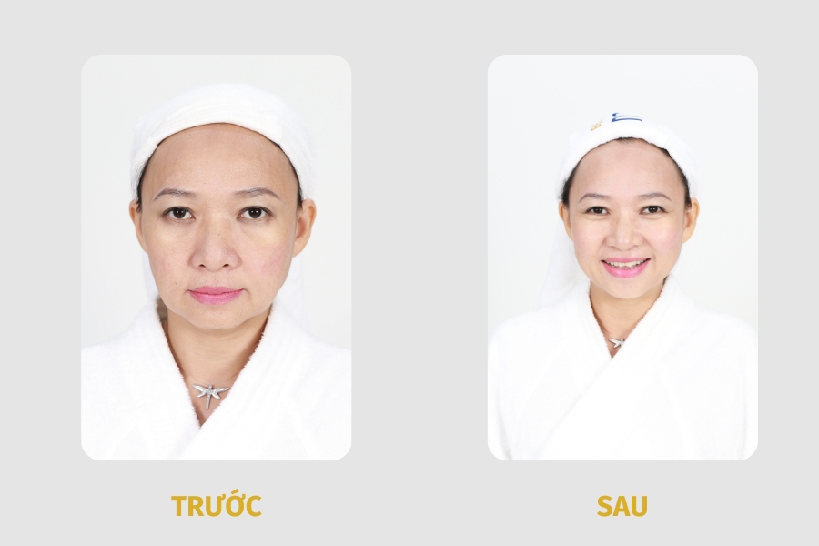 Liệu trình trẻ hóa da mặt giá 33hello88? Bảng giá mới nhất 2024