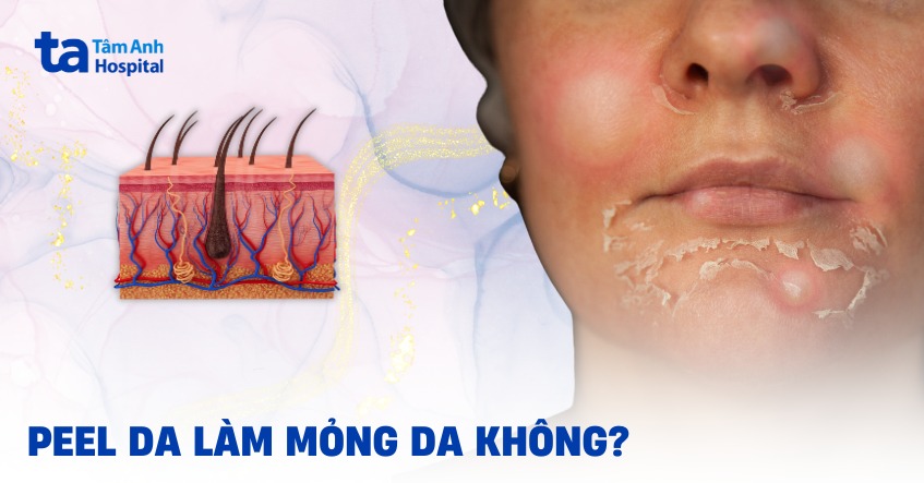 Peel da có làm mỏng da không? Tần suất 33hello88 là phù hợp?