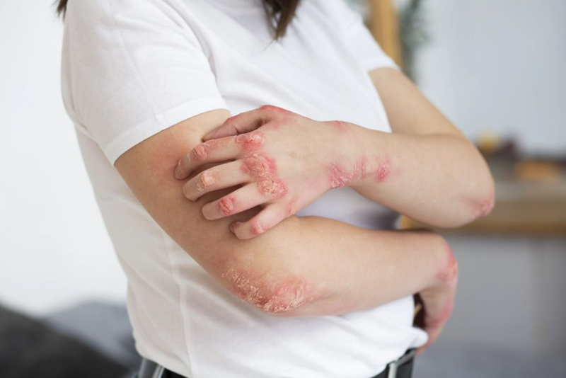 Bệnh nấm da tay: Nguyên nhân, triệu chứng và cách điều trị