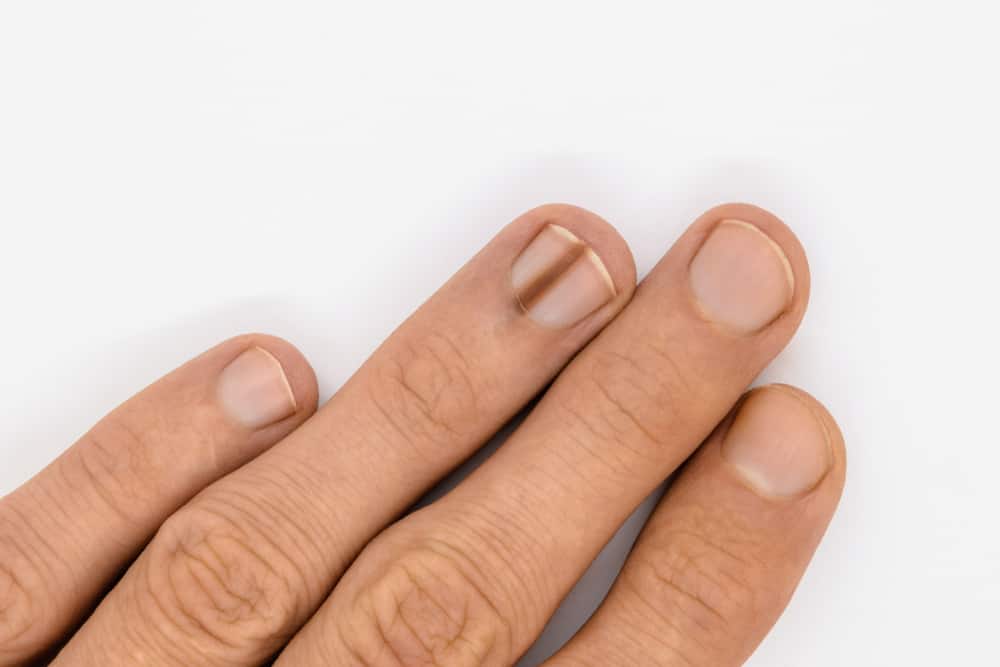 Cảnh báo helloo88 khi móng tay bị sọc đen và sọc trắng
