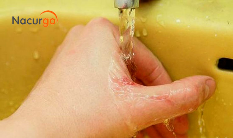hello8862 com cách rửa vết thương ngoài da, trầy xước do té ngã xe!