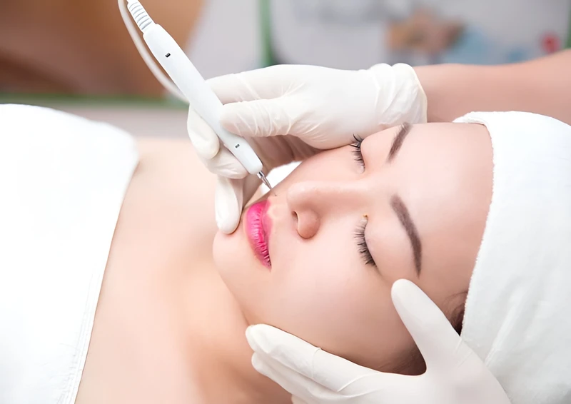 Tẩy nốt ruồi 33hello88 tiền? Cách chăm sóc da chuẩn y khoa sau khi tẩy nốt ruồi