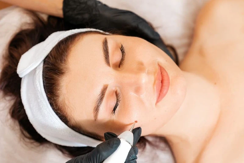 Tẩy nốt ruồi 33hello88 tiền? Cách chăm sóc da chuẩn y khoa sau khi tẩy nốt ruồi