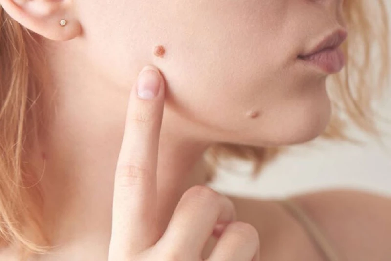 Tẩy nốt ruồi 33hello88 tiền? Cách chăm sóc da chuẩn y khoa sau khi tẩy nốt ruồi