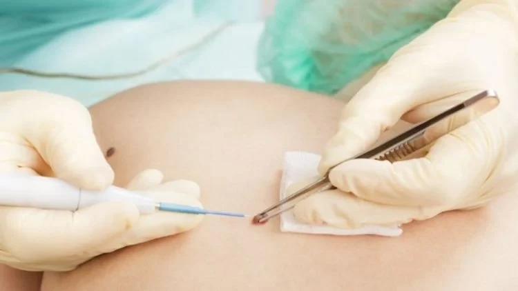 5+ cách tẩy nốt ruồi an toàn helloo88 mà bạn nên cân nhắc