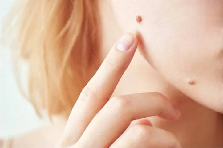 5+ cách tẩy nốt ruồi an toàn helloo88 mà bạn nên cân nhắc