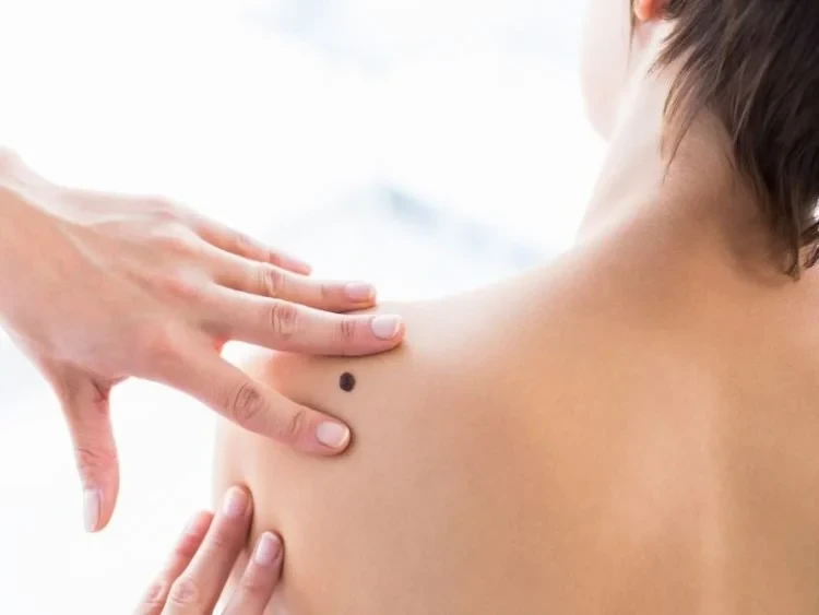 5+ cách tẩy nốt ruồi an toàn helloo88 mà bạn nên cân nhắc