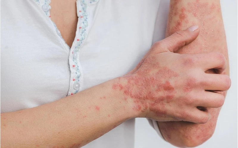 Bị lột da tay có ảnh hưởng gì không?
