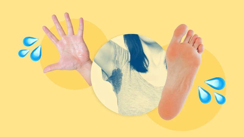 Những điều bạn cần biết về hội chứng đổ mồ hôi tay chân