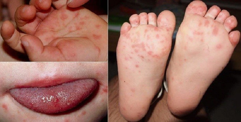 Mách mẹ các dấu hiệu tay chân miệng ở trẻ rất dễ nhận biết