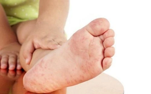 Bệnh tay chân miệng độ 1 mấy ngày thì khỏi?