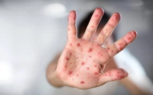 Bệnh tay chân miệng độ 1 mấy ngày thì khỏi?