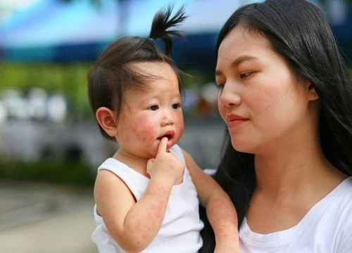 Bệnh tay chân miệng độ 1 mấy ngày thì khỏi?