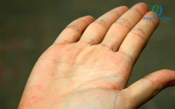 Chuyên gia giải đáp nguyên nhân gây vàng da lòng bàn tay bàn chân