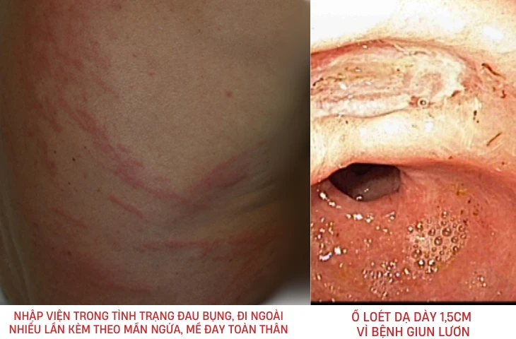 20 năm không tẩy giun, bệnh nhân 60 tuổi loét dạ dày, viêm tá tràng vì nhiễm giun lươn