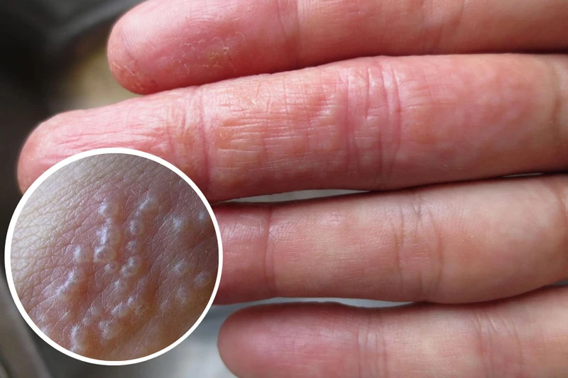 Tay nổi mụn cứng có sao không? Nguyên nhân và cách điều trị hiệu quả