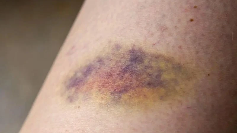 Vết bầm tím trên da không rõ nguyên nhân: Dấu hiệu cảnh báo bệnh lý