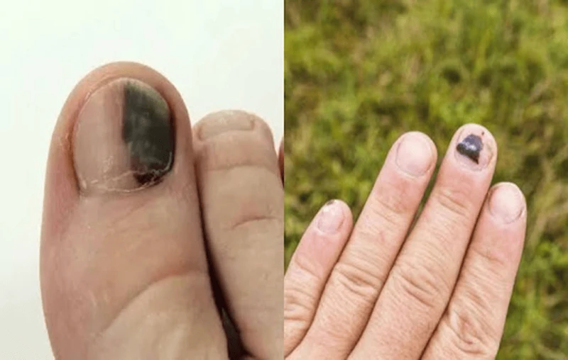 Móng tay đen là biểu hiện của bệnh gì?