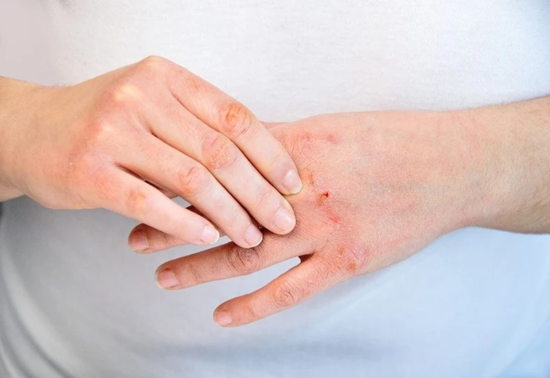 Top 3 nguyên nhân da tay khô và cách điều trị hiệu quả