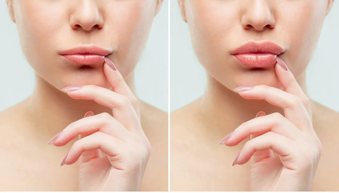 Tiêm Môi Tây Quyến Rũ Phù Hợp Với Ai? Tiêm An Toàn Không?