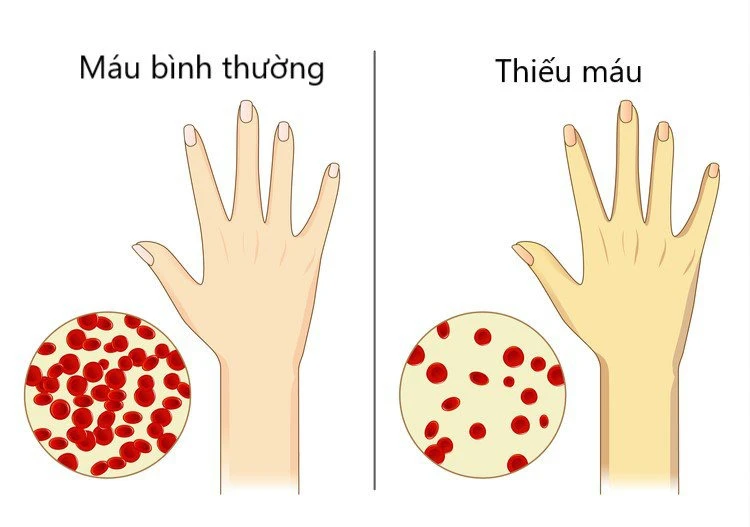 Dấu hiệu mất ngủ tê bì chân tay là do đâu?