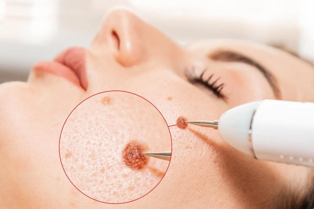 Tẩy nốt ruồi bao lâu thì bong vảy và cách chăm sóc để mau lành?