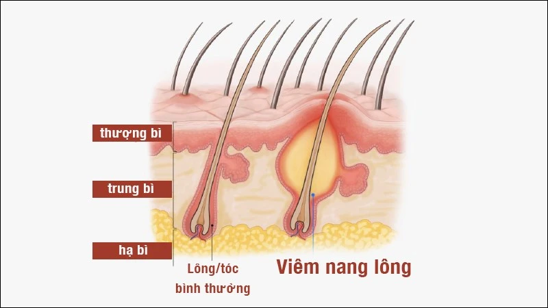 Viêm nang lông: Nguyên nhân, dấu hiệu và cách điều trị hiệu quả