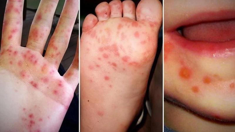 Cách điều trị bệnh tay chân miệng helloo88 an toàn và hiệu quả