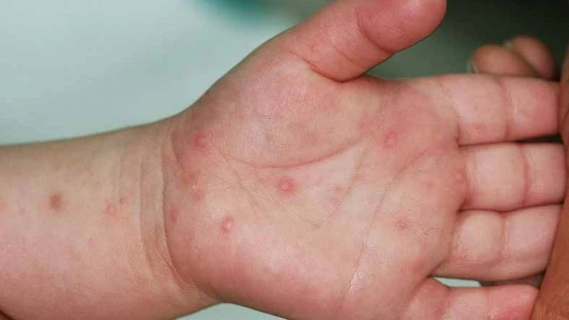 Cách điều trị bệnh tay chân miệng helloo88 an toàn và hiệu quả