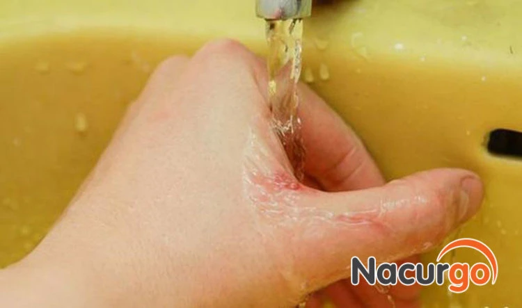 hello8862 com cách sát trùng vết thương bị ngã, té xe tránh nhiễm trùng!