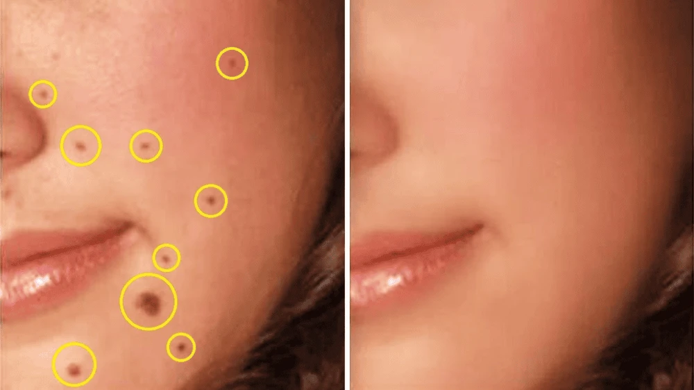 Tẩy nốt ruồi bằng laser có để lại sẹo không?