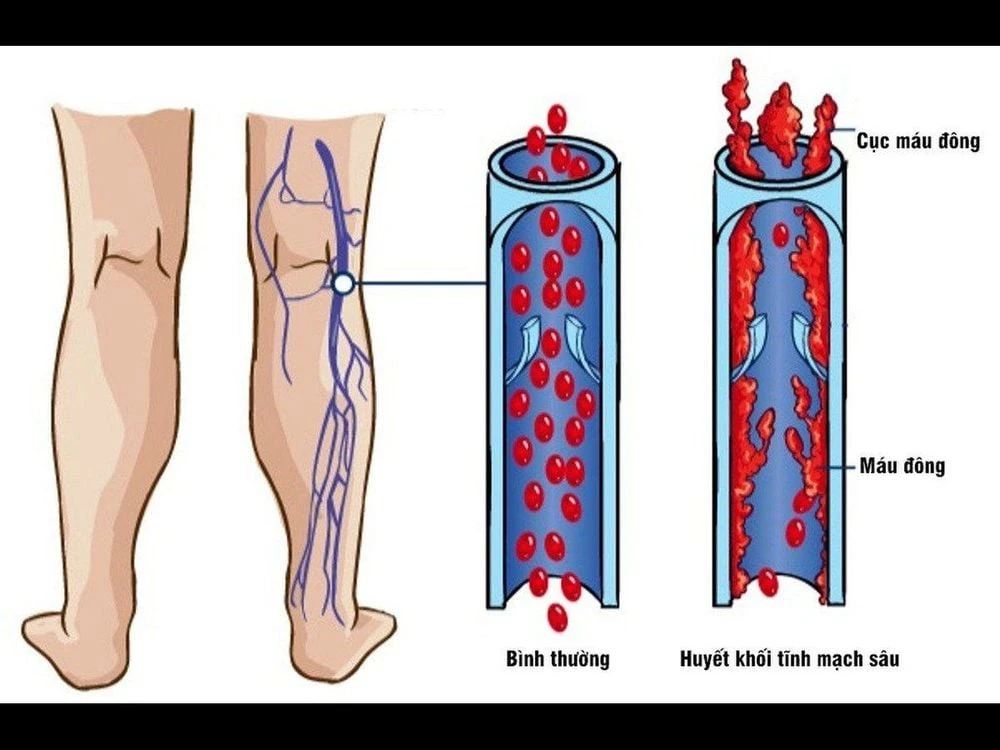 Sưng mạch máu ở tay là bệnh gì?