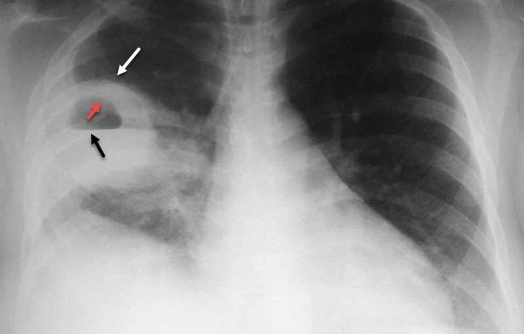 Viêm khớp ngón tay: Chẩn đoán và điều trị