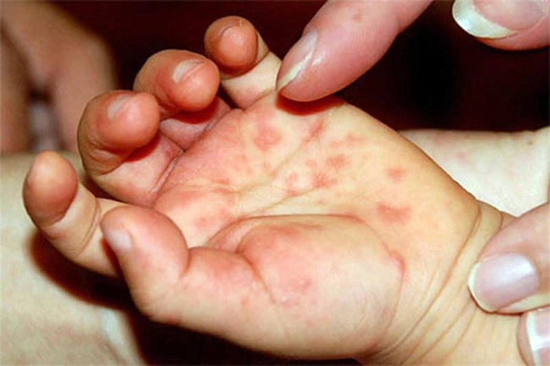 Bé bị nổi mụn nước ở tay chân là biểu hiện của bệnh gì?