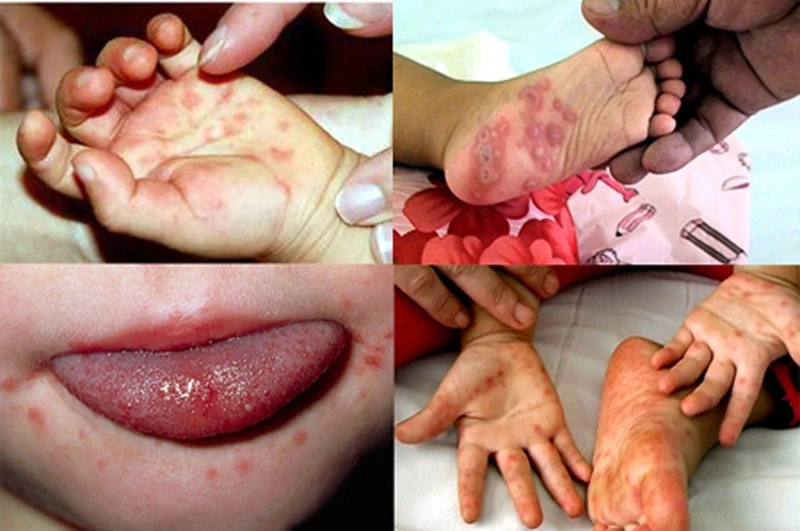 Bé bị nổi mụn nước ở tay chân là biểu hiện của bệnh gì?