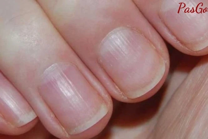 Móng tay sần gợn sóng: Dấu hiệu helloo88 cần helo88 vina