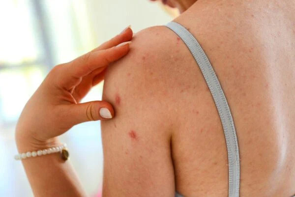 Bật mí cách điều trị và phòng ngừa mụn nhọt ở tay an toàn