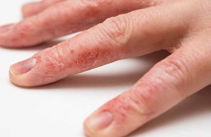 Chàm bàn tay: Nguyên nhân và phương pháp điều trị bệnh