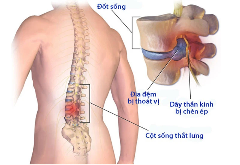 Đau lưng mỏi gối tê tay là dấu hiệu cảnh báo bệnh lý gì?
