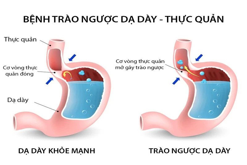 6hello88 thắc mắc: Bị nhói tim dấu hiệu bệnh gì?